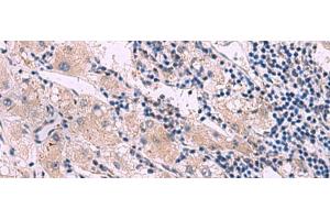Immunohistochemistry of paraffin-embedded Human liver cancer tissue using NMRK2 Polyclonal Antibody at dilution of 1:55(x200) (ITGB1BP3 anticorps)