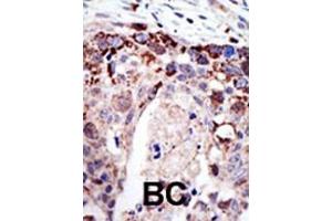 Formalin-fixed and paraffin-embedded human cancer tissue reacted with the primary antibody, which was peroxidase-conjugated to the secondary antibody, followed by AEC staining. (Ataxin 3 anticorps  (N-Term))
