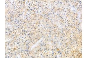 ABIN6266031 and ABIN6269398 at 1/100 staining human hepatocellular carcinoma by IHC-P. (WNK1 anticorps  (N-Term))