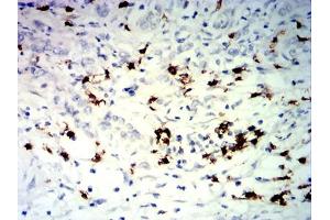 Immunohistochemical analysis of paraffin-embedded stomach cancer tissues using TNFRSF25 mouse mAb with DAB staining. (DR3/LARD anticorps)