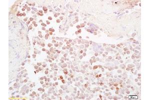 Formalin-fixed and paraffin embedded mouse colon carcinoma labeled with Anti-NQO1 Polyclonal Antibody, Unconjugated (ABIN678428) at 1:200, followed by conjugation to the secondary antibody and DAB staining (NQO1 anticorps  (AA 201-274))