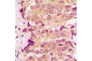 Immunohistochemical analysis of p38 staining in human breast cancer formalin fixed paraffin embedded tissue section.