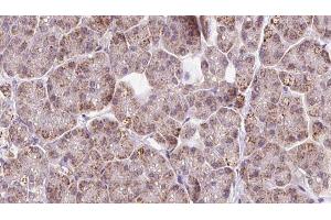 ABIN6273243 at 1/100 staining Human pancreas cancer tissue by IHC-P. (FBXO22 anticorps  (Internal Region))