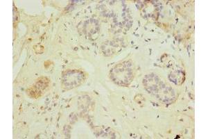 Immunohistochemistry of paraffin-embedded human breast cancer using ABIN7165622 at dilution of 1:100 (C17orf66 anticorps  (AA 1-219))