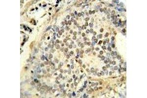 FUS antibody immunohistochemistry analysis in formalin fixed and paraffin embedded human prostate carcinoma.