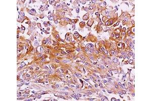 IHC testing of melanoma tissue stained with Melanoma antibody (NKI-beteb). (Melanoma anticorps)