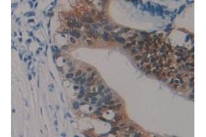 Detection of S100P in Human Pancreatic cancer Tissue using Polyclonal Antibody to S100 Calcium Binding Protein P (S100P)