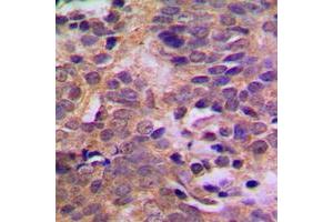 Immunohistochemical analysis of MDM2 (pS166) staining in human breast cancer formalin fixed paraffin embedded tissue section.