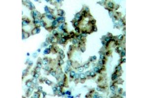 Immunohistochemistry of paraffin-embedded human lung carcinoma tissue, using Phospho-PKCalpha/beta II-T638/641 antibody (ABIN3019760, ABIN3019761, ABIN3019762, ABIN1681948 and ABIN1681949). (PRKCA/PRKCB (pThr638), (pThr641) anticorps)
