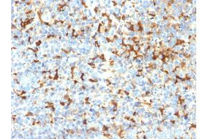 Formalin-fixed, paraffin-embedded human Melanoma stained with TYRP1 Recombinant Rabbit Monoclonal (TYRP1/2340R); DAB Chromogen.