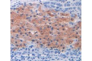 IHC-P analysis of Human Liver Cancer Tissue, with DAB staining.