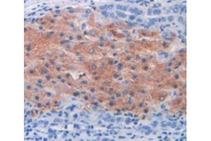 IHC-P analysis of Human Liver Cancer Tissue, with DAB staining. (MUC2 anticorps  (AA 5075-5179))