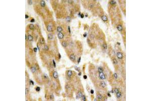 Immunohistochemical analysis of Fibronectin staining in human liver cancer formalin fixed paraffin embedded tissue section. (Fibronectin anticorps  (C-Term))