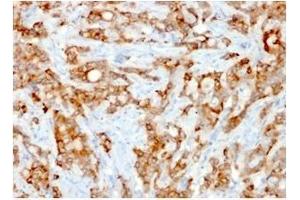 Formalin-fixed, paraffin-embedded human Lung Carcinoma stained with Beta-2-Microglobulin Mouse Recombinant Monoclonal Antibody (rB2M/961).