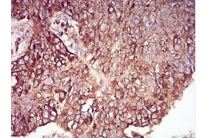 Immunohistochemical analysis of paraffin-embedded lung cancer tissues using Rab6b mouse mAb with DAB staining.