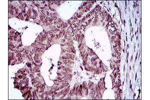 Immunohistochemical analysis of paraffin-embedded rectum cancer tissues using ZEB1 mouse mAb with DAB staining. (ZEB1 anticorps  (AA 967-1108))