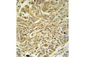 Immunohistochemistry analysis in formalin fixed and paraffin embedded lung carcinoma reacted with GSTK1 Antibody (Center) followed by peroxidase conjugation of the secondary antibody and DAB staining. (GSTK1 anticorps  (Middle Region))