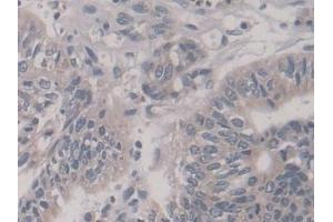 Detection of KIF18A in Human Stomach cancer Tissue using Polyclonal Antibody to Kinesin Family, Member 18A (KIF18A)