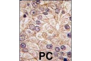 Formalin-fixed and paraffin-embedded human prostata carcinoma tissue reacted with PI4K II beta antibody (N-term), which was peroxidase-conjugated to the secondary antibody, followed by DAB staining. (PI4K2B anticorps  (N-Term))
