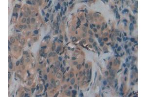 DAB staining on IHC-P; Samples: Human Breast cancer Tissue (Transferrin Receptor 2 anticorps  (AA 211-405))