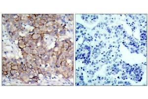 Immunohistochemical analysis of paraffin-embedded human breast carcinoma tissue, using HER2 (phospho- Tyr877) antibody (E011075). (ErbB2/Her2 anticorps  (pTyr877))