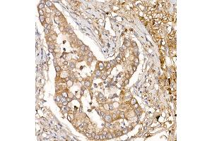 Immunohistochemistry of paraffin-embedded human lung cancer using NUMB Rabbit pAb (ABIN6129424, ABIN6144943, ABIN6144944 and ABIN6224990) at dilution of 1:150 (40x lens).
