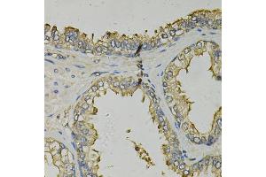 Immunohistochemistry of paraffin-embedded human prostate using FABP1 Antibody (ABIN5973056) at dilution of 1/100 (40x lens). (FABP1 anticorps)