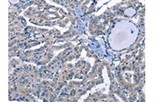 The image on the left is immunohistochemistry of paraffin-embedded Human thyroid cancer tissue using (LRRK2 Antibody) at dilution 1/30, on the right is treated with fusion protein. (LRRK2 anticorps)