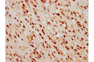 IHC image of ABIN7172910 diluted at 1:500 and staining in paraffin-embedded human glioma performed on a Leica BondTM system.