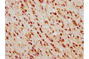IHC image of ABIN7172910 diluted at 1:500 and staining in paraffin-embedded human glioma performed on a Leica BondTM system. (TSNAX anticorps  (AA 1-87))
