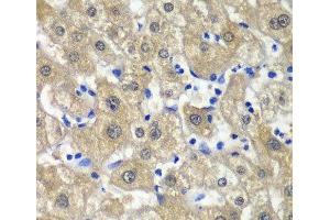 Immunohistochemistry of paraffin-embedded Human liver damage using MAT1A Polyclonal Antibody at dilution of 1:100 (40x lens). (MAT1A anticorps)