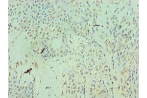 Immunohistochemistry of paraffin-embedded human breast cancer using ABIN7154577 at dilution of 1:100 (RAN anticorps  (AA 1-216))