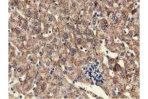 Immunohistochemical staining of paraffin-embedded Carcinoma of Human lung tissue using anti-UHMK1 mouse monoclonal antibody.