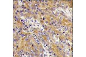 Formalin-fixed and paraffin-embedded human prostata carcinoma tissue reacted with MYO1C antibody (C-term), which was peroxidase-conjugated to the secondary antibody, followed by DAB staining.