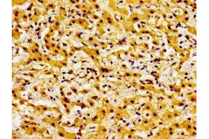 Immunohistochemistry of paraffin-embedded human liver cancer using ABIN7145314 at dilution of 1:100 (BOK anticorps  (AA 15-103))