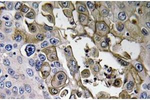 Immunohistochemistry (IHC) analyzes of RAGE antibody in paraffin-embedded human lung carcinoma tissue. (RAGE anticorps)