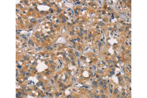 Immunohistochemistry (IHC) image for anti-Carcinoembryonic Antigen-Related Cell Adhesion Molecule 6 (CEACAM6) antibody (ABIN2426691) (CEACAM6 anticorps)