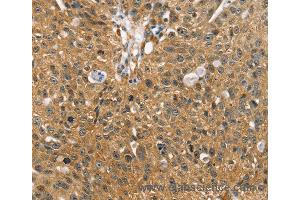 Immunohistochemistry of Human breast cancer using SORT1 Polyclonal Antibody at dilution of 1:35 (Sortilin 1 anticorps)
