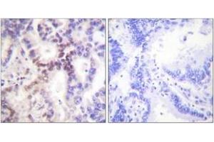 Immunohistochemistry analysis of paraffin-embedded human lung carcinoma tissue, using p15 INK Antibody.
