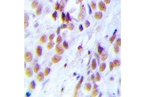 Immunohistochemical analysis of LSm4 staining in human breast cancer formalin fixed paraffin embedded tissue section.
