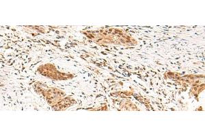 Immunohistochemistry of paraffin-embedded Human esophagus cancer tissue using TEAD3 Polyclonal Antibody at dilution of 1:50(x200) (TEAD3 anticorps)