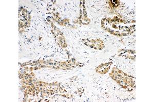 Anti-Caspase-3(P10),  IHC(P) IHC(P): Human Lung Cancer Tissue (Caspase 3 anticorps  (C-Term))