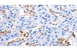 Immunohistochemistry of paraffin-embedded Human lung cancer tissue using MFN1 Polyclonal Antibody at dilution 1:60 (MFN1 anticorps)