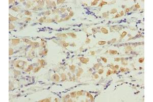 Immunohistochemistry of paraffin-embedded human gastric cancer using ABIN7171717 at dilution of 1:100 (SMG6 anticorps  (AA 251-511))