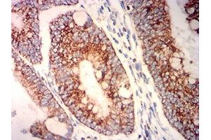Immunohistochemical analysis of paraffin-embedded rectum cancer tissues using PLA2G7 mouse mAb with DAB staining. (PLA2G7 anticorps  (AA 22-441))