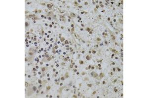 Immunohistochemistry of paraffin-embedded human liver cancer using INTS6 Antibody. (INTS6 anticorps)