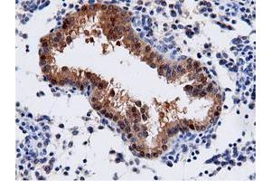 Immunohistochemical staining of paraffin-embedded Adenocarcinoma of Human endometrium tissue using anti-AK5 mouse monoclonal antibody. (Adenylate Kinase 5 anticorps)