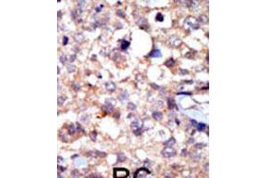 Formalin-fixed and paraffin-embedded human cancer tissue reacted with the primary antibody, which was peroxidase-conjugated to the secondary antibody, followed by AEC staining. (ABL1 anticorps  (C-Term))