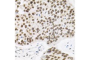 Immunohistochemistry of paraffin-embedded human lung cancer using BAF60a antibody. (SMARCD1 anticorps)
