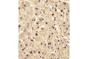 (ABIN6242566 and ABIN6578504) staining PGM1 in human liver tissue sections by Immunohistochemistry (IHC-P - paraformaldehyde-fixed, paraffin-embedded sections). (Phosphoglucomutase 1 anticorps  (AA 251-282))